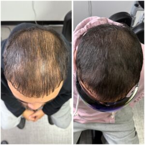 Men’s Density Fill